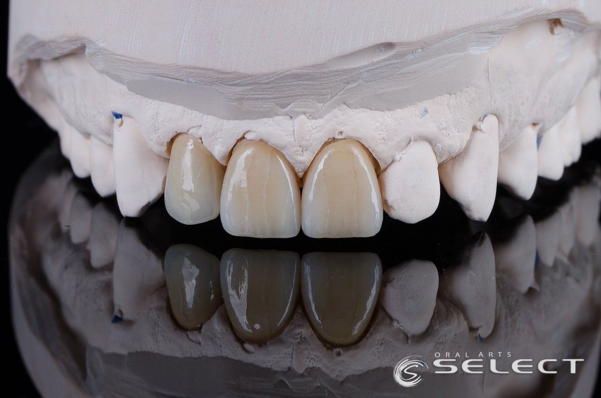 OralArtsDental's tweet photo. Amazing color and detail with these IPS e.max veneers. This patient will for sure be amazed by these results.
#OralArtsHuntsville #OralArtsDental #OralArtsHville #OralArtsDentalLab #OralArtsHSV #DentalLab #DentalLife #Dentistry #OralArtsSELECT #SmileMakeOver #IPSEMAX #EMAX https://t.co/1lZ4S9I1Xe
