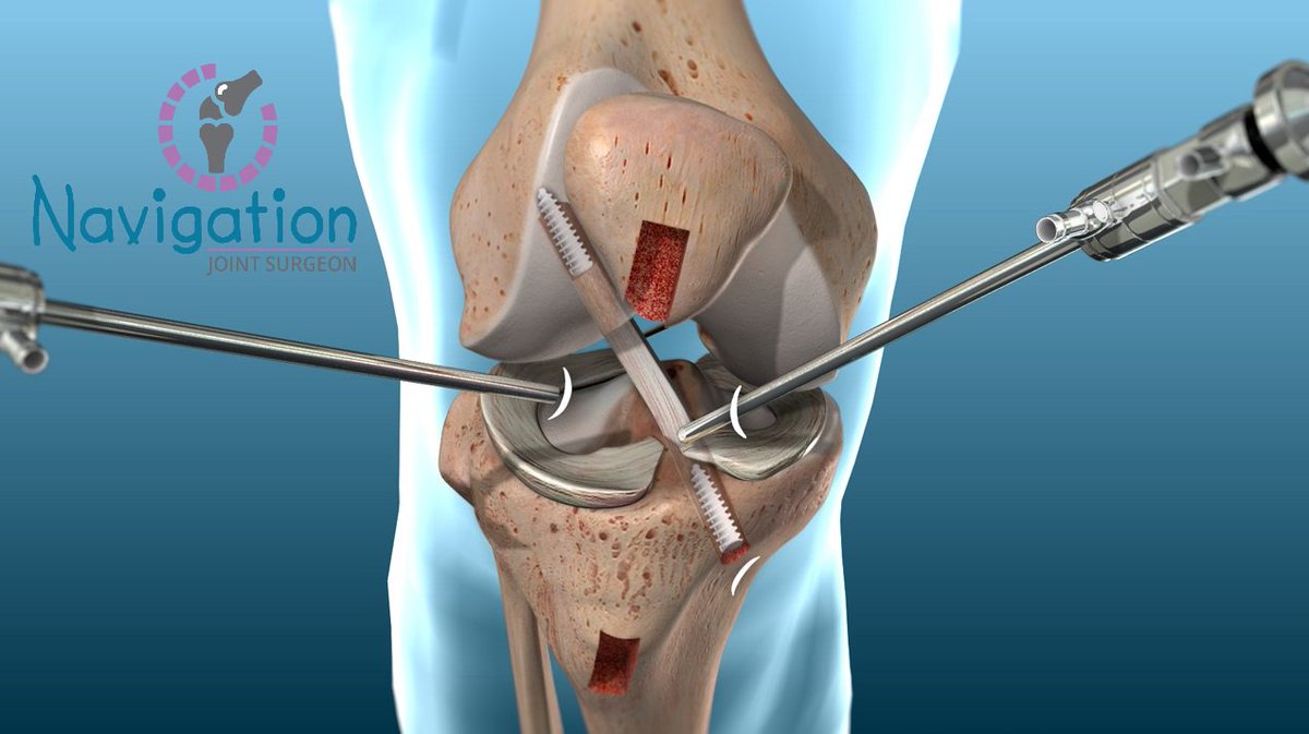 KirthiPaladugu's tweet photo. Best Knee Replacement Surgeon in hyderabad. who have formulated a reputation of providing superlative and innovative Knee Surgery to their patients. #knee_replacement #hip_replacement #shoulder_replacement
#ankle_injuries #arthroscopy #trauma #accidents
https://t.co/H3blIztmfz https://t.co/A57G8twpcE