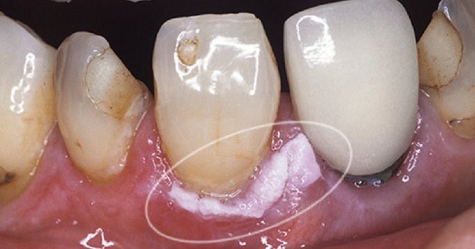 Leukoplakia Gums
