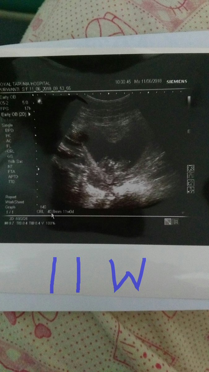 p_sari04's tweet photo. Walaupun mama batuk2 trs sampe ga bisa tidur, dd harus tetap sehat... Gpp mama hrs nginep 1malam di 'hotel bintang 7' demi kesehatan mu nak #2ndpregnancy #11week https://t.co/lq0PY7iZzc