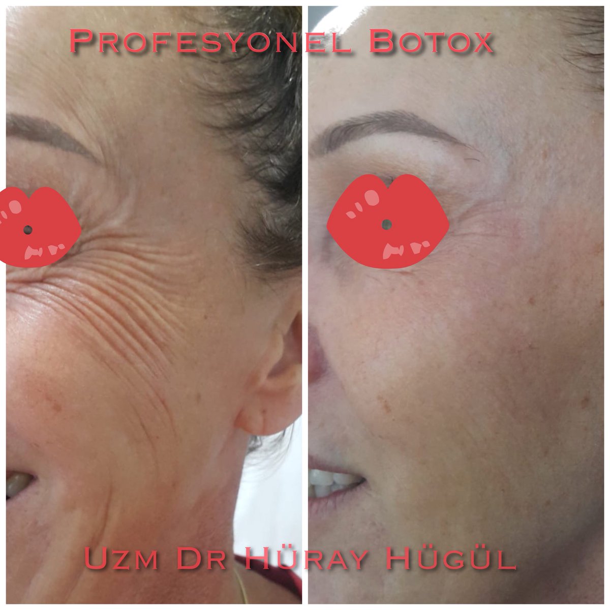 PROFESYONEL BOTOX UYGULAMALARI; Kaş arası kızgınlık çizgilerine, alındaki martı kanadı çizgilerine, göz çevresi kaz ayaklarına, burundaki çizgilere mimikleri bozmadan kırışıklıkları azaltacak şekilde uygulanır ☺️ 02423240003 ve 05454047222 Lara Vatan Bilgisayar Yanı/ Antalya
