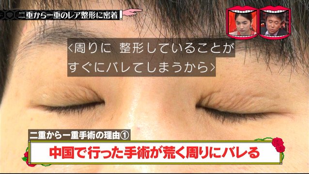 二重を一重に整形する人いない説 を調べていたら 陰嚢スポーティ整形 とか 掟破りの短小整形 とかレア整形の事例がすご過ぎた 水曜日のダウンタウン 2ページ目 Togetter