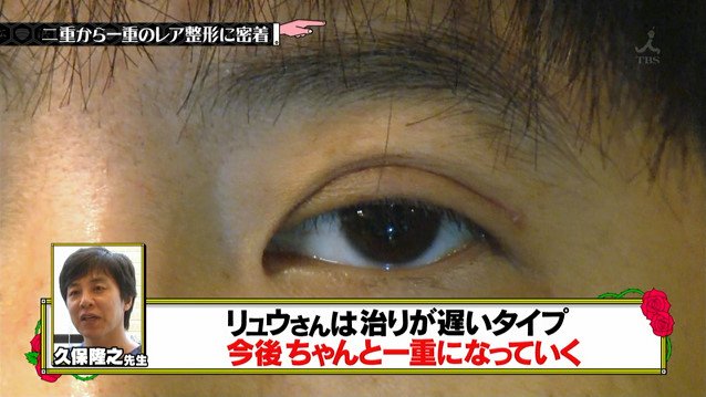 二重を一重に整形する人いない説 を調べていたら 陰嚢スポーティ整形 とか 掟破りの短小整形 とかレア整形の事例がすご過ぎた 水曜日のダウンタウン 2ページ目 Togetter 二重を一重に整形する人いない説 を調べていたら 陰嚢スポーティ整形 とか 掟破りの短小整形 とかレア整形の事例がすご過ぎた 水曜日のダウンタウン 2ページ目 Togetter