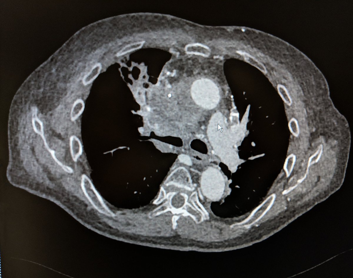 SOBE_Vascular's tweet photo. 75 yo M long term smoker, mediastinal #SCC and #SVCsyndrome. #IRAD can #recan for palliation. @penumbrainc #aspiratedontmacerate @BardPV #fluency #inlineflow @BOlivieriMD @DrBobBeasley https://t.co/OC230Nw3e4