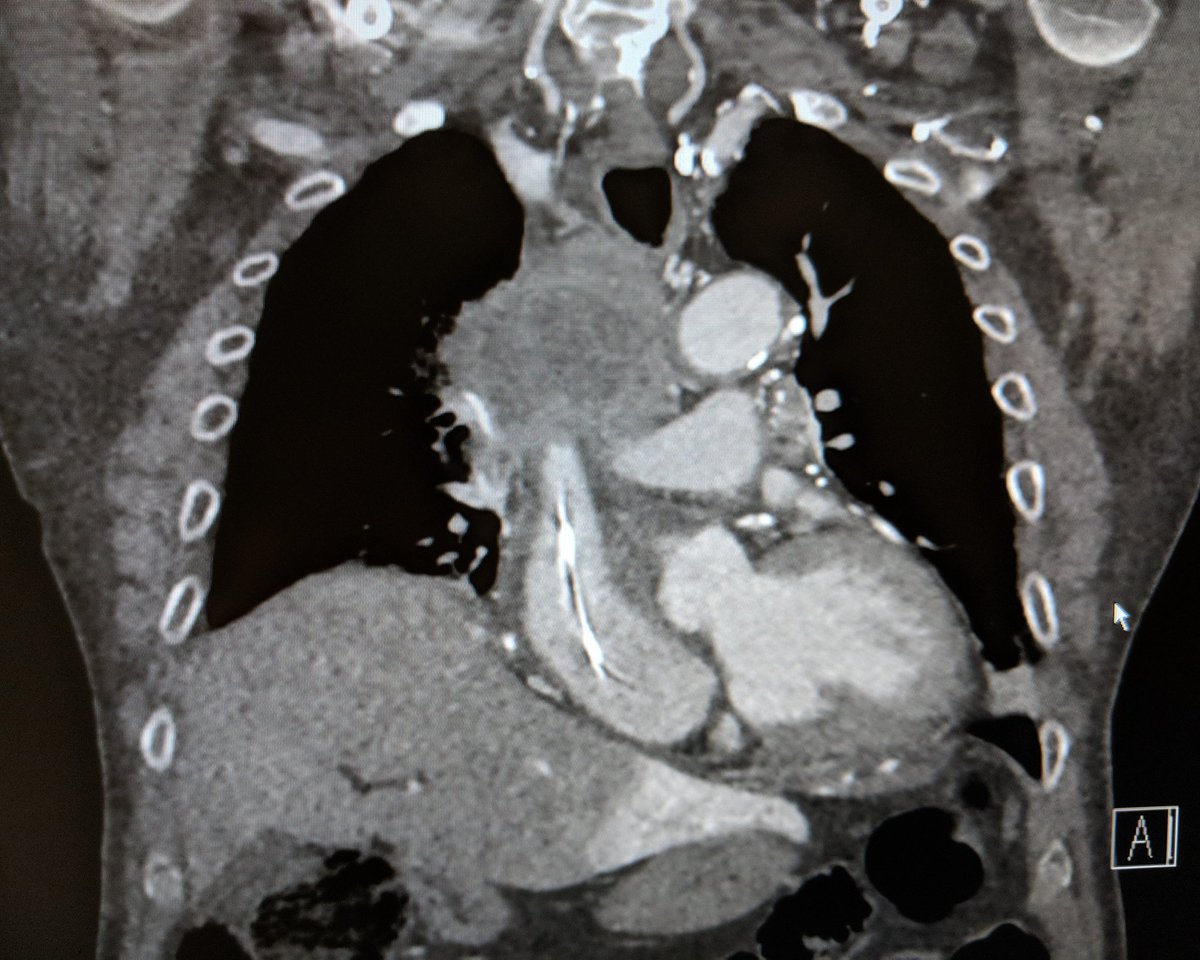 SOBE_Vascular's tweet photo. 75 yo M long term smoker, mediastinal #SCC and #SVCsyndrome. #IRAD can #recan for palliation. @penumbrainc #aspiratedontmacerate @BardPV #fluency #inlineflow @BOlivieriMD @DrBobBeasley https://t.co/OC230Nw3e4