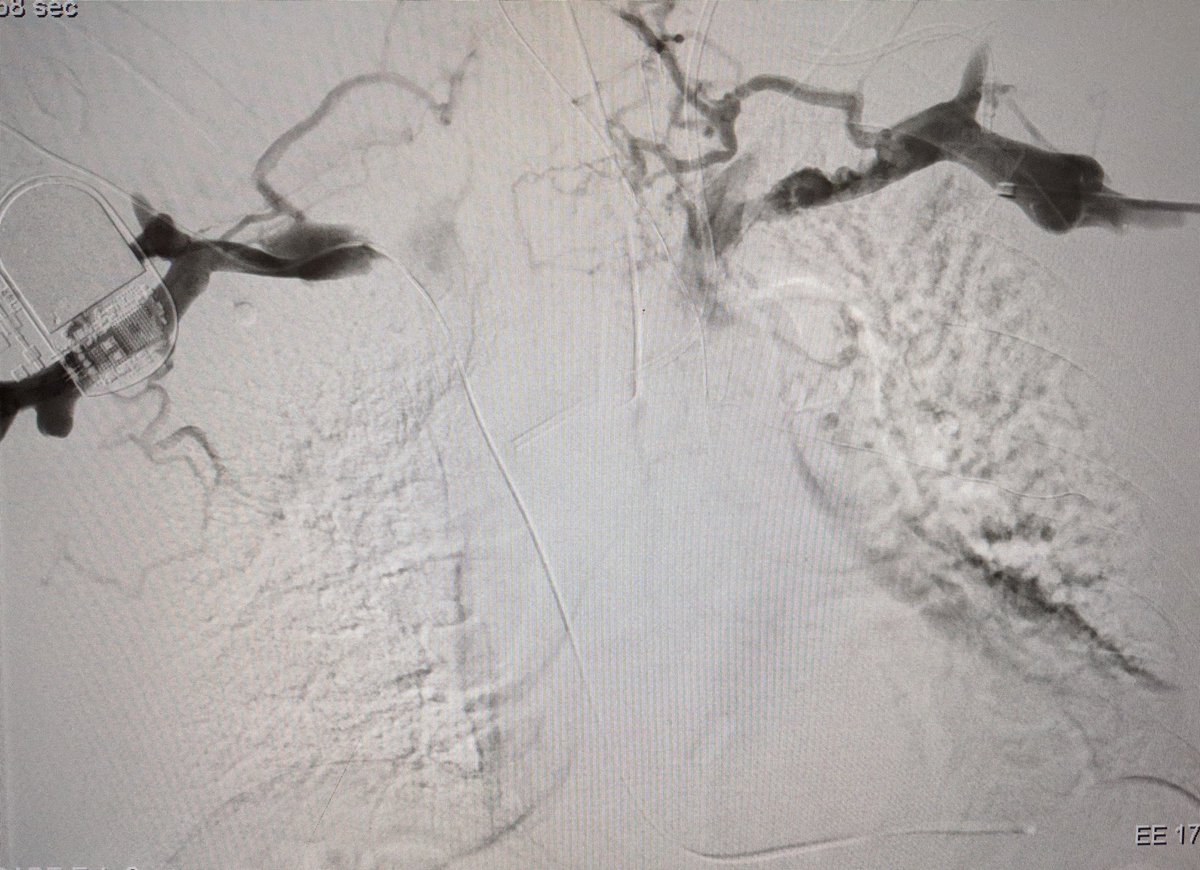 SOBE_Vascular's tweet photo. 75 yo M long term smoker, mediastinal #SCC and #SVCsyndrome. #IRAD can #recan for palliation. @penumbrainc #aspiratedontmacerate @BardPV #fluency #inlineflow @BOlivieriMD @DrBobBeasley https://t.co/OC230Nw3e4