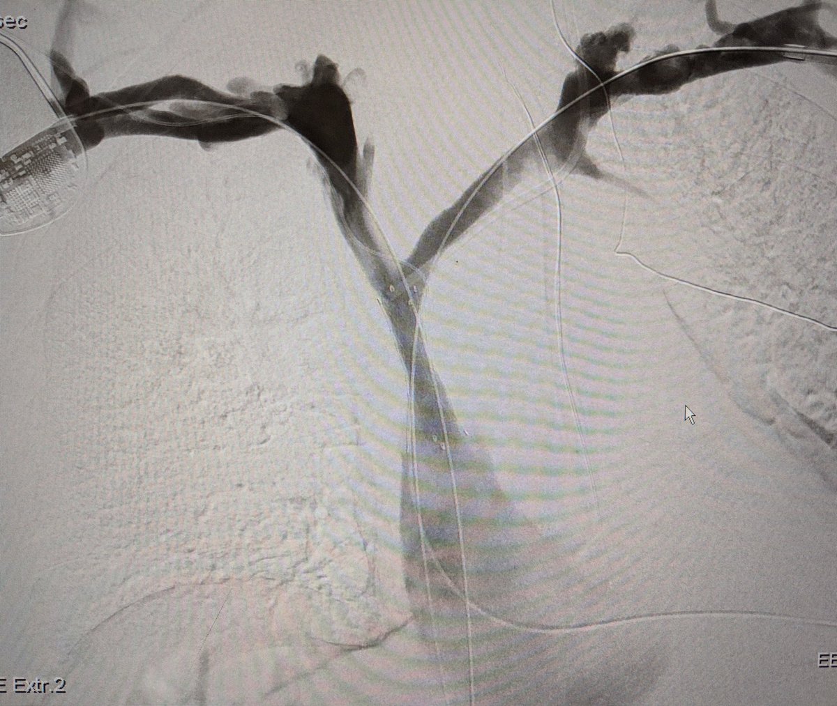 SOBE_Vascular's tweet photo. 75 yo M long term smoker, mediastinal #SCC and #SVCsyndrome. #IRAD can #recan for palliation. @penumbrainc #aspiratedontmacerate @BardPV #fluency #inlineflow @BOlivieriMD @DrBobBeasley https://t.co/OC230Nw3e4