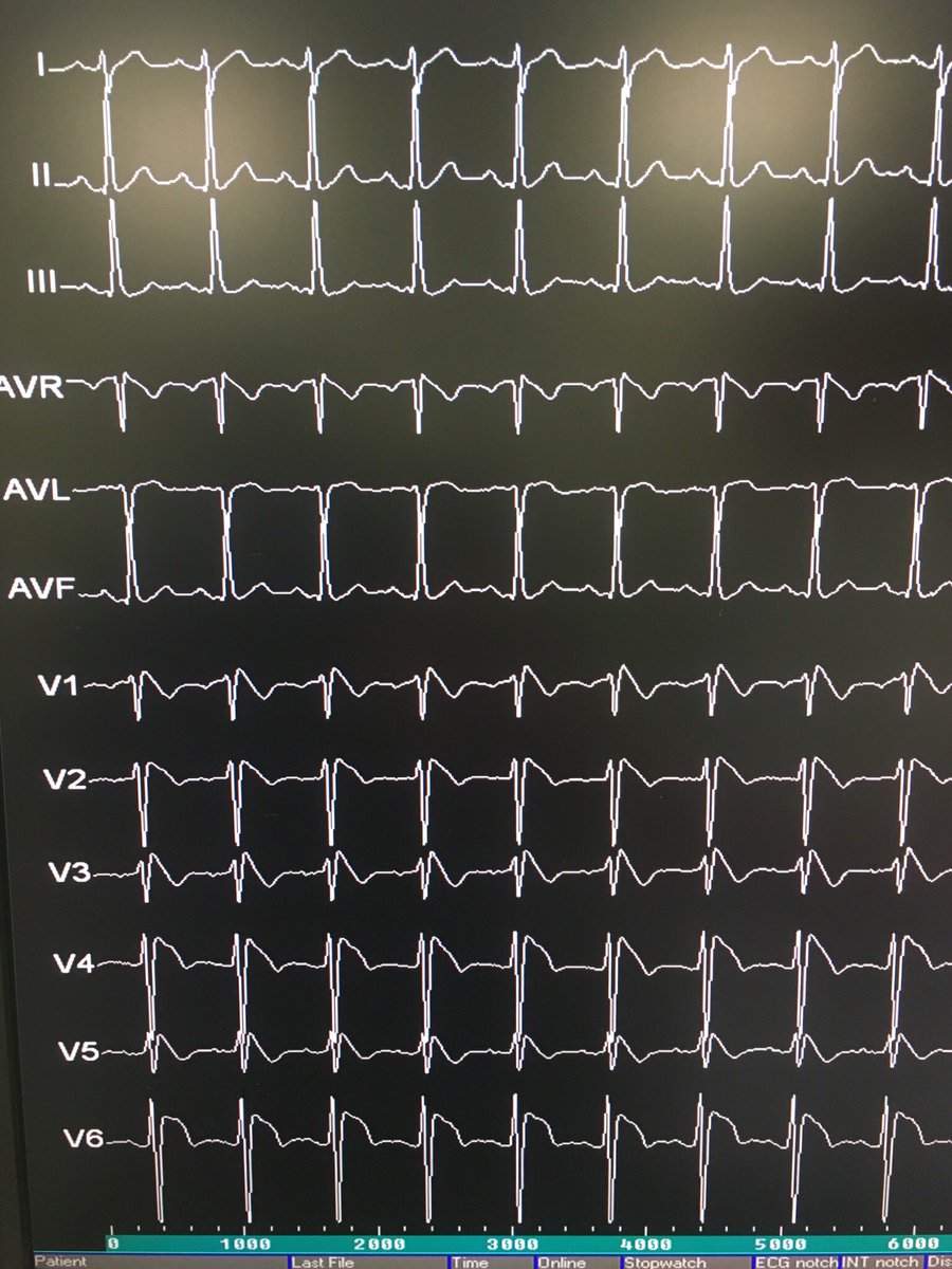 Could there be a better evidence for Brugada syndrome than postive ajmaline test performed by its disoverer? Happy birthday Dr @josep_brugada! #BrugadaSyndrome #HospitalClinic #Barcelona