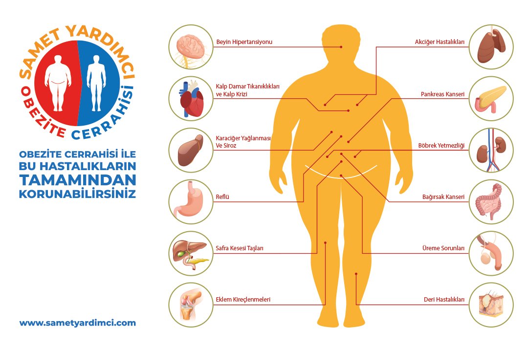 Obezite cerrahisi ile bu hastalıkların tamamından korunabilirsiniz #obesity #obesitysurgery #mideküçültme #tüpmide #gastrikbypass #diyabet #metabolikcerrahi #fit #beslenme #şekerhastalığı #tip2diyabet #obezitecerrahisi #tüpmideameliyatı #hastalık #korunma