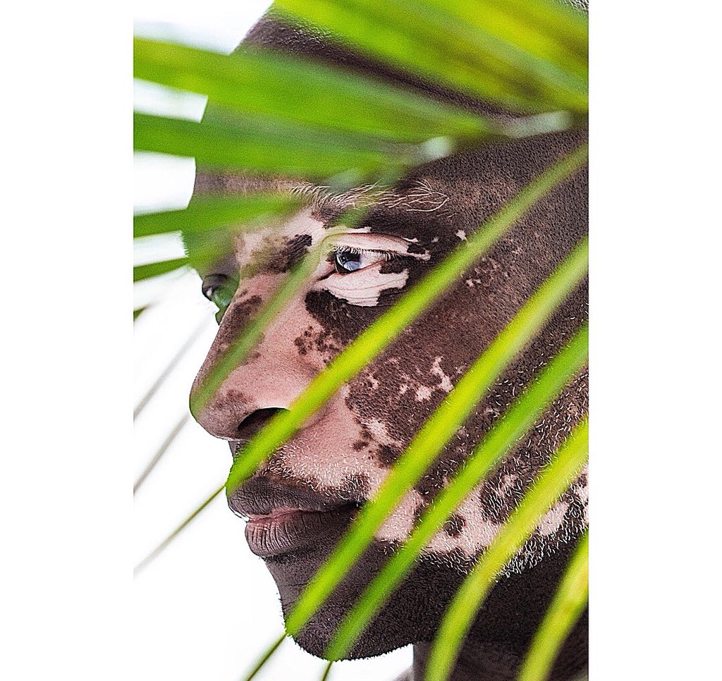 iamjamesmcleod's tweet photo. Embrace your inner beauty with confidence!! 📸 @jitskenap @NewYorkModels #beauty #model #confidence #vitiligo #photography #Ariversluis https://t.co/8Yap4lhBfk