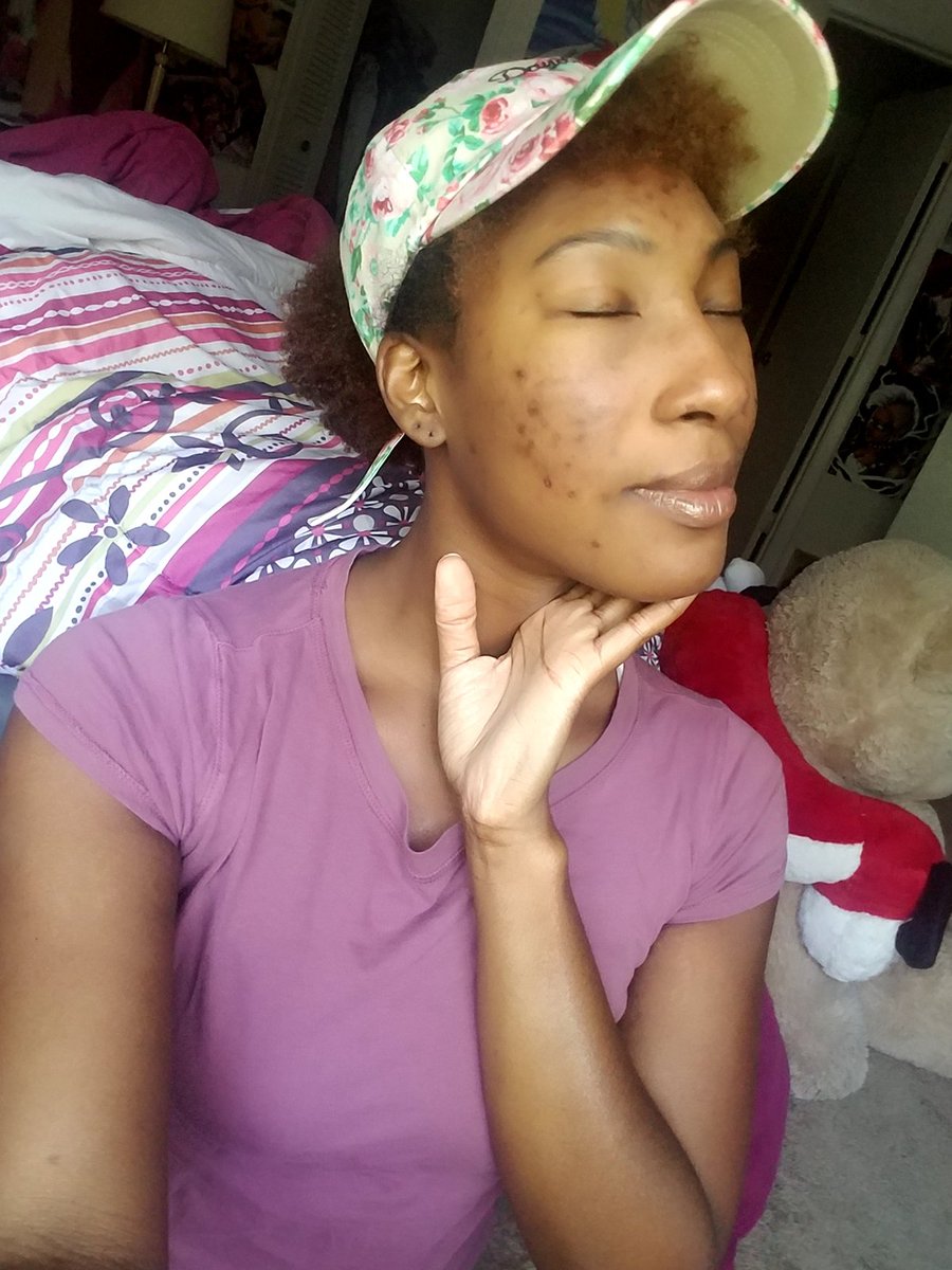 Fudgie_Monster's tweet photo. Black women are always shown with their skin being glowy and clear of imperfections

But every black woman isn't like that. We have dark spots,  acne scars, and all the between. And I'm not scared to show it.  

I'm beautiful even if my skin isn't clear 💕
#loveyourskin https://t.co/Pr7pti4QOg