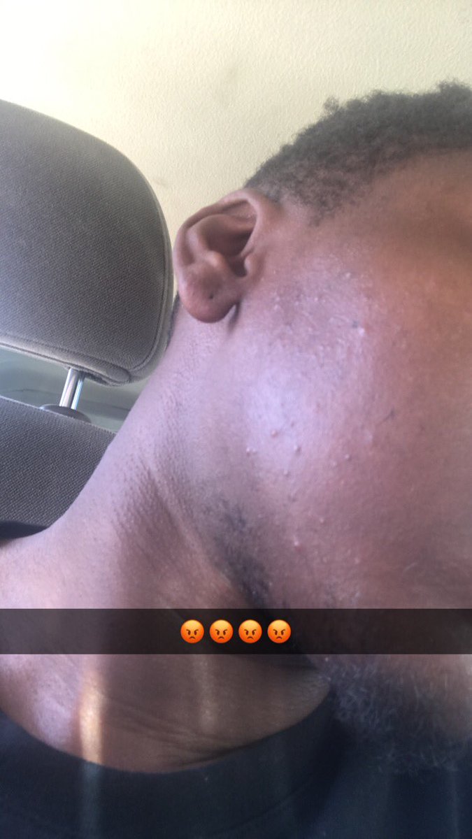 Princesekushi's tweet image. I’m not used to having acne this bad something save me #acne #faceproblems