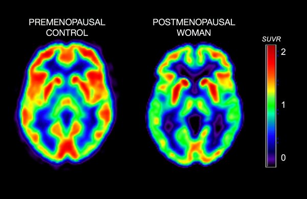 GeorgeIbrahimMD's tweet photo. Can premenopausal #hormonetherapy help alleviate the symptoms of Alzheimers?
Read more https://t.co/k39B8ddq80

#bodybyBRM #womenshealth #alzheimers #prevention https://t.co/HG8leIFA7b