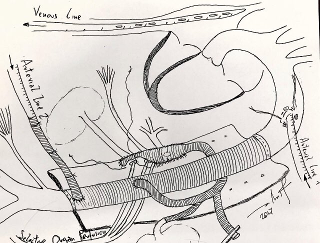 Aortarepaircom's tweet photo. Complex thoracoabdominal aortic aneurysm repair at #Mountsinaihospital #aorticdissection #marfanfoundation #aorta https://t.co/BjXClNwgWL