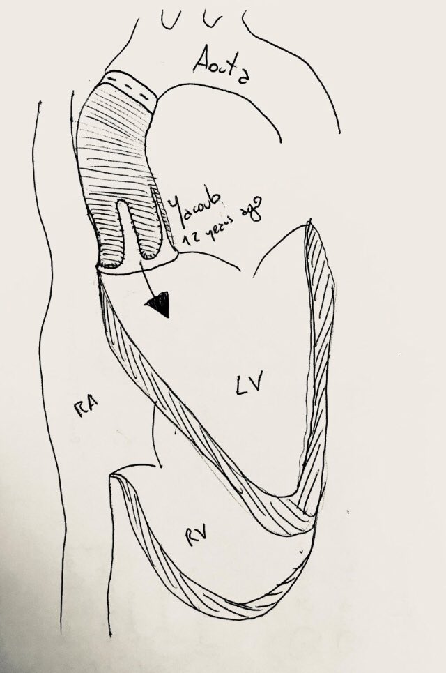 Aortarepaircom's tweet photo. Complex #Aortic Root #aneurysm surgery #bentallprocedure #davidprocedure #marfan #marfansyndrome #marfanfoundation https://t.co/Vgr1aZU8RA