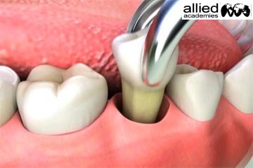 pulling of Teeth #teethextraction effect of extraction #loosing of gum
for more discussion on teeth extraction: bit.ly/2Iak9li
#dentalcongress #dentalconference..