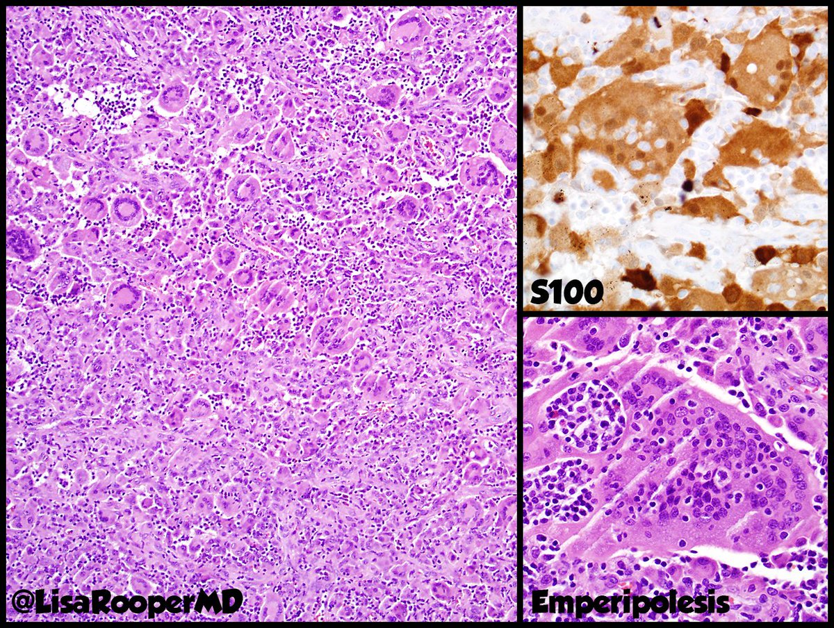 Lisa Rooper En Twitter Learned A New Pitfall A Subset Of Juvenile Xanthogranulomas Are S100 With Emperipolesis And Can Be Mistaken For Rosai Dorfman They Otherwise Have Classic Jxg Morphology With Touton Giant
