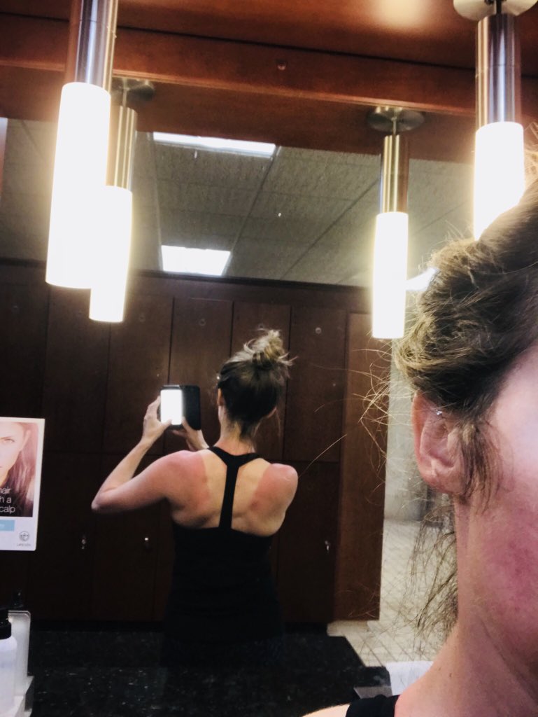 _CynthiaThurlow's tweet photo. What’s wrong with this photo?! 😱😳😆 #Sunburn #forgotmysunscreen #ouch #Sunny #chtwellness https://t.co/ezOTlJgyOu