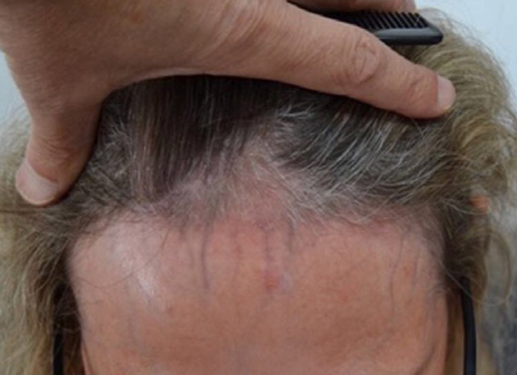 Publican desde Australia casos de #alopecia frontal fibrosante que mejoran simplemente al suspender el uso de cremas de protección solar.  ncbi.nlm.nih.gov/pubmed/2989685… #dermatología #tricoHRC