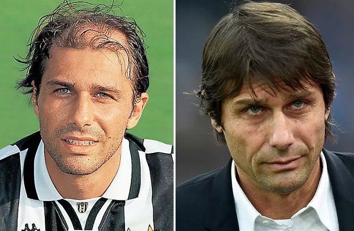 CrownClinicUK's tweet photo. In our latest blog we explain Chelsea manager Antonio Conte's amazing hair transformation - #hairtransplant #fueprocedure
https://t.co/8IDgZ9hYnl https://t.co/YmWQuMalpz