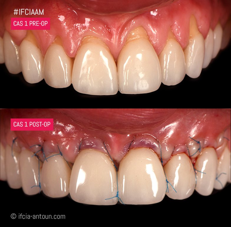 IFCIA_Paris's tweet photo. Et voilà ! Cas 1 session #ifciaam, le résultat post-op, chirurgie par Dr Sofia Aroca en collaboration avec les Drs Jeremy Abitbol, Paul Challita, Ons Zouiten.
#ifciaam #amenagmentsmuqueux #gencive #greffegencive #implandentistry #implantology #implantologie #implantdentistry https://t.co/67dogyhv4l