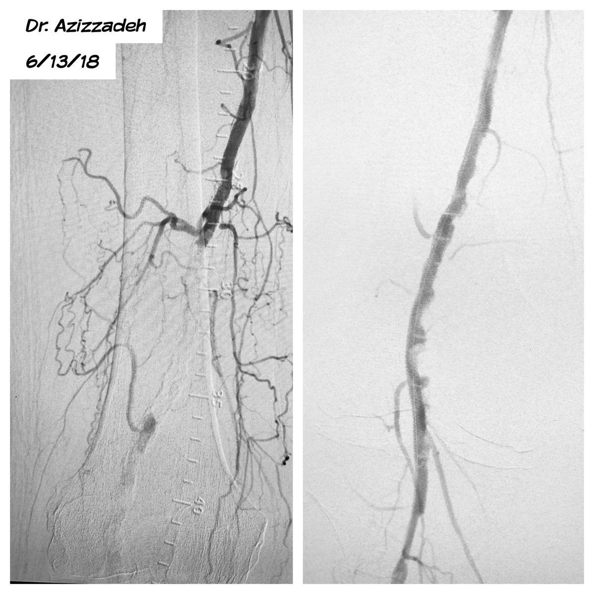 DrAliAzizzadeh's tweet photo. #PAD #CLI #toeulcer #popliteal #occlusion treated with #PTA #Stent #vascularsurgery @CedarsSinai https://t.co/ZQiUtSKy4G