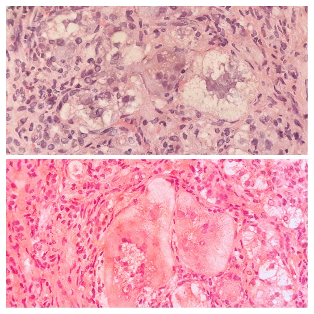 4 mo boy with -Post infantil giant cell hepatitis CMV related. End stage.#pathology #hepatitis