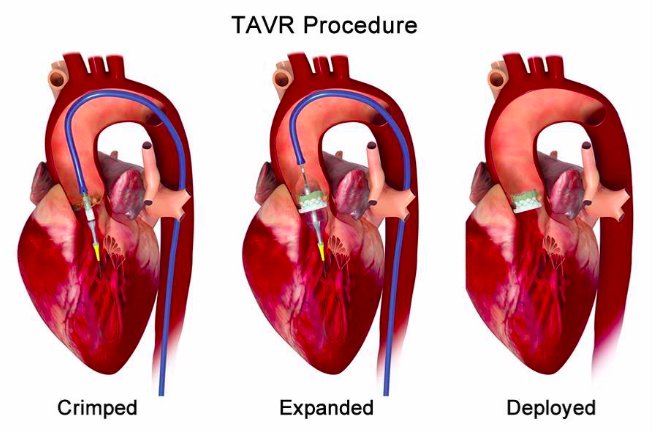CRT_meeting's tweet photo. #NewerGeneration #transcatheterheartvalves have improved upon older models in their efficacy for patients with severe non-calcified native #aorticregurgitation, but much work remains to be done, according to a #registrystudy.
Full story: https://t.co/pe4f4R2bIV https://t.co/q8ANkh2LwG