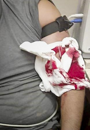 Tramedic's tweet photo. Workplace injuries can happen in the blink of an eye. Here a circular saw fell onto a worker & cut an artery in his left arm. A @TacticalMedical SOFTT-W was applied to save his life (📸 @TacRescueServ) #tourniquet #traumakit #stopthebleed #workplacesafety #softtw #accidentshappen https://t.co/GA9RkwmDa2