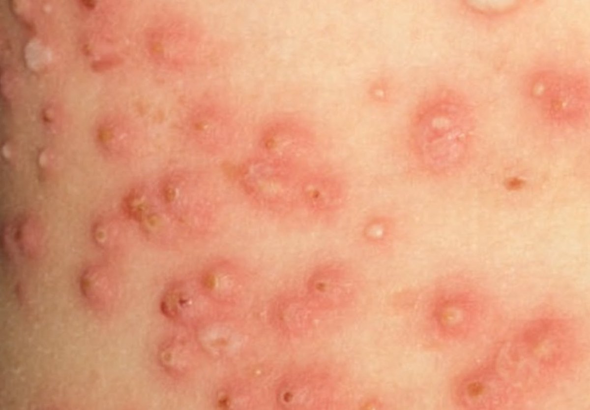 ElInformanteMX's tweet photo. En la colonia #LasDalias #Torreon una escuela fue cerrada, se detectaron 6 casos de #impétigo, infección contagiosa provocada por las bacterias #estafilococos o #estreptococos, producen ampollas o llagas en el rostro, así como en las manos y las piernas.
https://t.co/WOXwTEundd https://t.co/mbt7yXLxHn