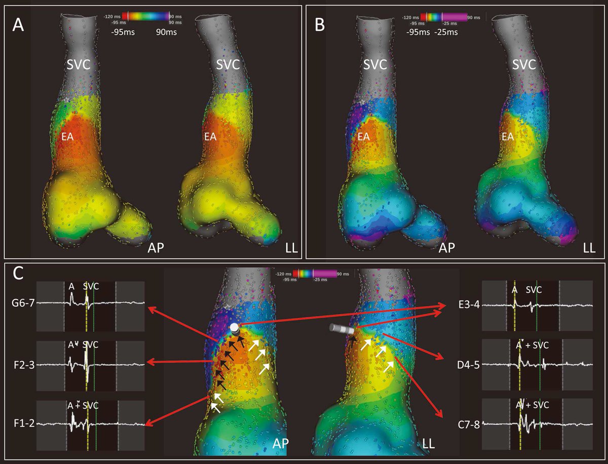 Cool Paper.

Novel Ablation Strategy for Isolating the Superior Vena Cava Using Ultra High-Resolution Mapping #ablateAF #Rhythmia  doi.org/10.1253/circj.…