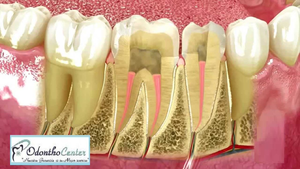 DraDuvalC's tweet image. La causa más frecuente de la infección y consecuente inflamación y necrosis de la pulpa, y por tanto de la necesidad de realizar una #endodoncia, es la existencia de #caries, aunque existen otros factores que pueden generar una #pulpitis o lesión de la pulpa. #OdonthoCenter