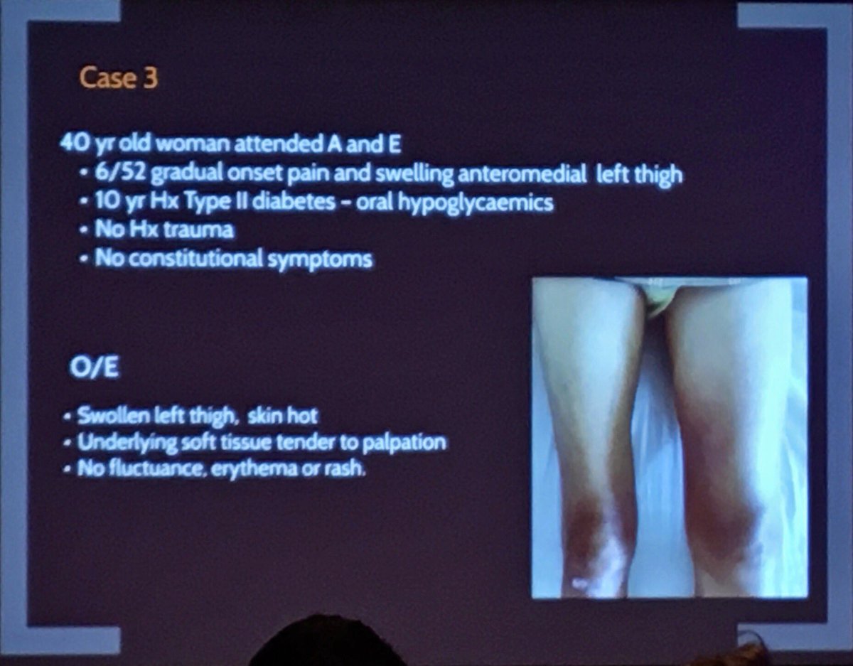 Britt_NL's tweet photo. Uncommon, underdiagnosed complication of diabetes mellitus: diabetic myonecrosis
Most common in lower limbs
Poor long term outcome
By Khanna Monica @imperialcollege
#ESSR2018 @ESSRmsk https://t.co/Rup238Cv5R