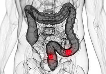 TWCMED's tweet photo. La realización de pruebas diagnósticas como la #colonoscopia, la #colonoscopiavirtual y el #test de sangre oculta en heces es fundamental para evitar la aparición del #cáncerdecolon.
https://t.co/dLNUU7wuEM https://t.co/ppwyiv7nYO