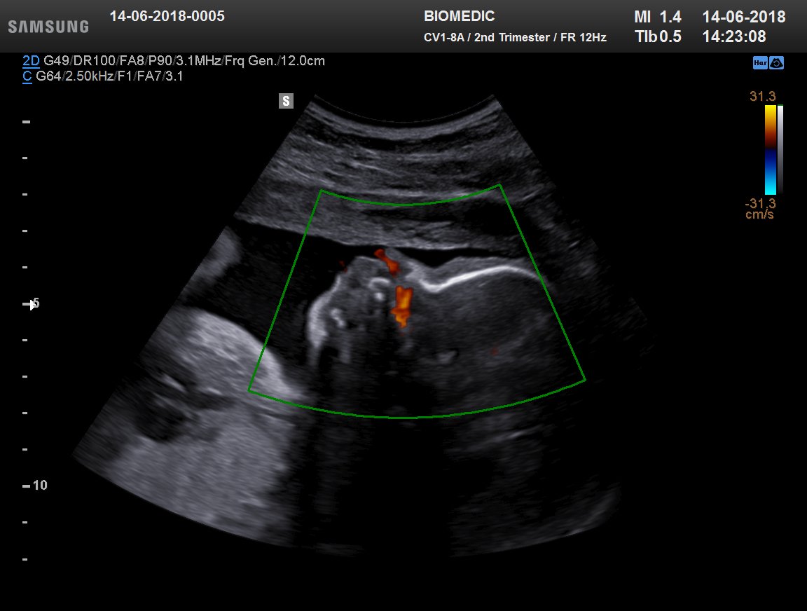 Prachtig in beeld gebracht: foetale ademhalingsbewegingen. #Samsung #echografie #ultrasound