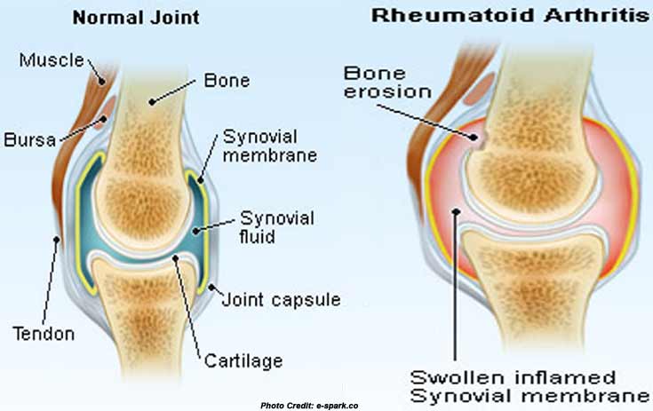 Dieta para artritis reumatoide