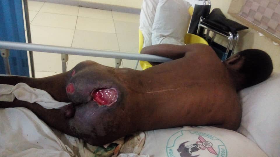 YemieFash's tweet photo. Hello TL, This is Taiwo Adedeji, he had an accident Last year November which affected his spinal cord, he has done the spinal cord surgery &amp; need to do another surgery, he has an outstanding bill of ₦1,004085 and needs ₦250,000 for the second surgery, let's help him. THREAD! https://t.co/Qo2MQozeqt