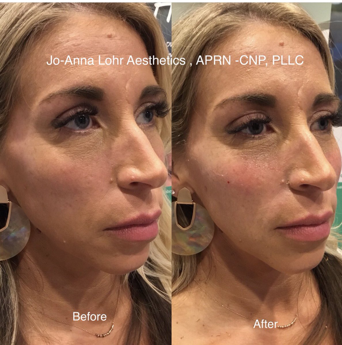 RadianOK's tweet photo. Some before &amp; after photos during our live demonstration of a Cheek Augmentation at last nights event! We added subtle volume to provide an overall lifted appearance while reducing the appearance of under eye circles. Call for an appointment to get your next filler on the books! https://t.co/UIAdKrw7Sv