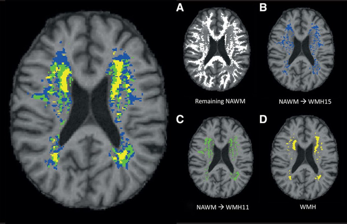 StrokeAHA_ASA's tweet photo. Progression of White Matter Hyperintensities Preceded by Heterogeneous Decline of Microstructural Integrity. #stroke https://t.co/8X2L1vlUGw https://t.co/4Bdb4Oqpko