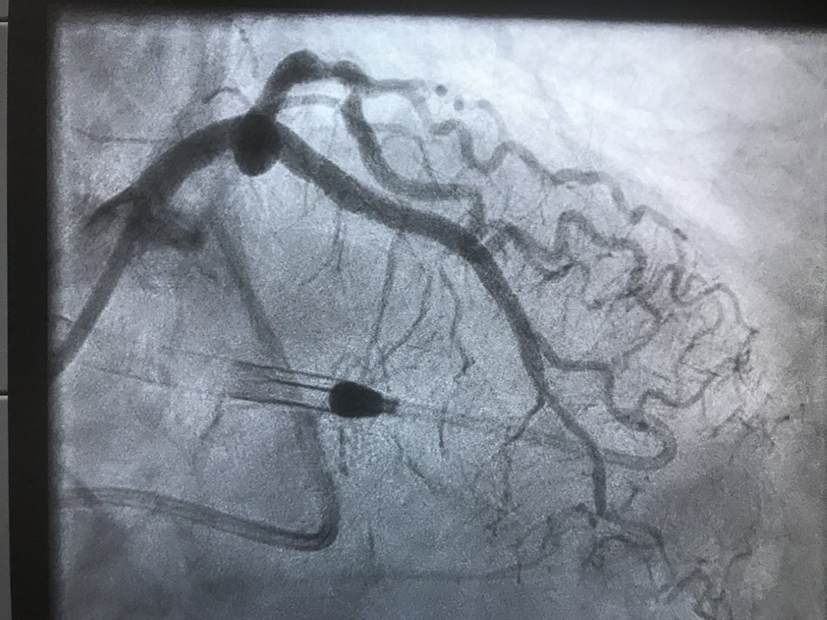 DrAmirKaki's tweet image. Eid Mubarak to all celebrating.  Great #PercAx #protectedPCI case by Raj Marok and Dave Wohns in critical LM surgical turndown vacsculopath with porcelain Ao and hostile PAD and EF 20%.#chip #MIACC #onemichigan #HappyEidMubarak #nyctomichigan