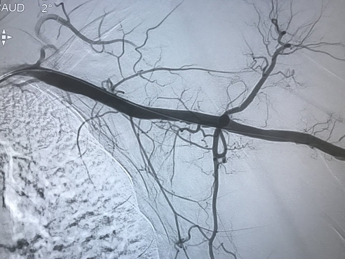 DrAmirKaki's tweet image. Eid Mubarak to all celebrating.  Great #PercAx #protectedPCI case by Raj Marok and Dave Wohns in critical LM surgical turndown vacsculopath with porcelain Ao and hostile PAD and EF 20%.#chip #MIACC #onemichigan #HappyEidMubarak #nyctomichigan