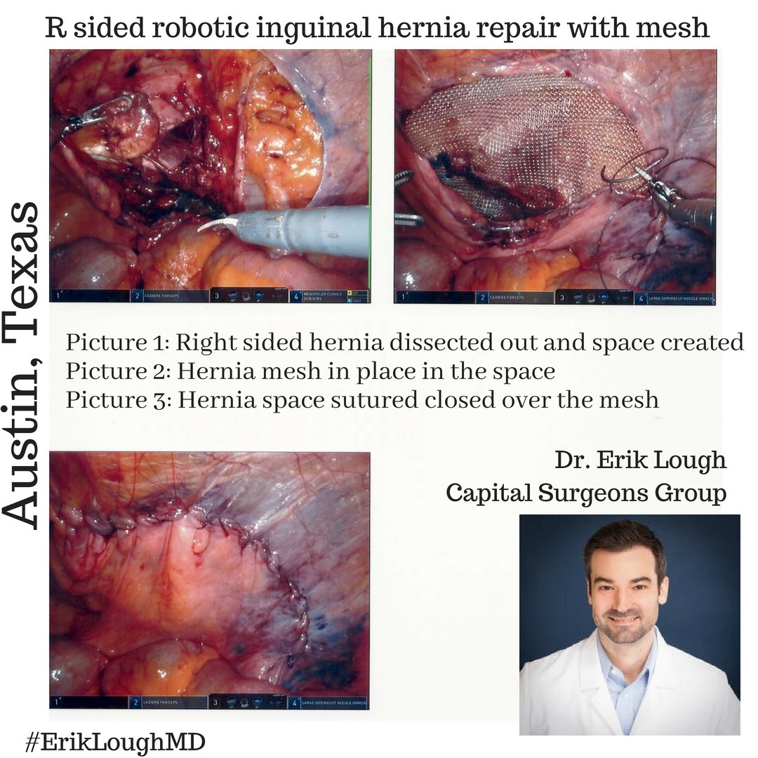 Just finished repairing an inguinal hernia. Helping patients one at a time and giving them my undivided attention makes all the difference in patient experience. #herniarepair #surgery #capitalsurgeonsgroup #ErikLoughMD #austinTX #patientcare #WhatsInside