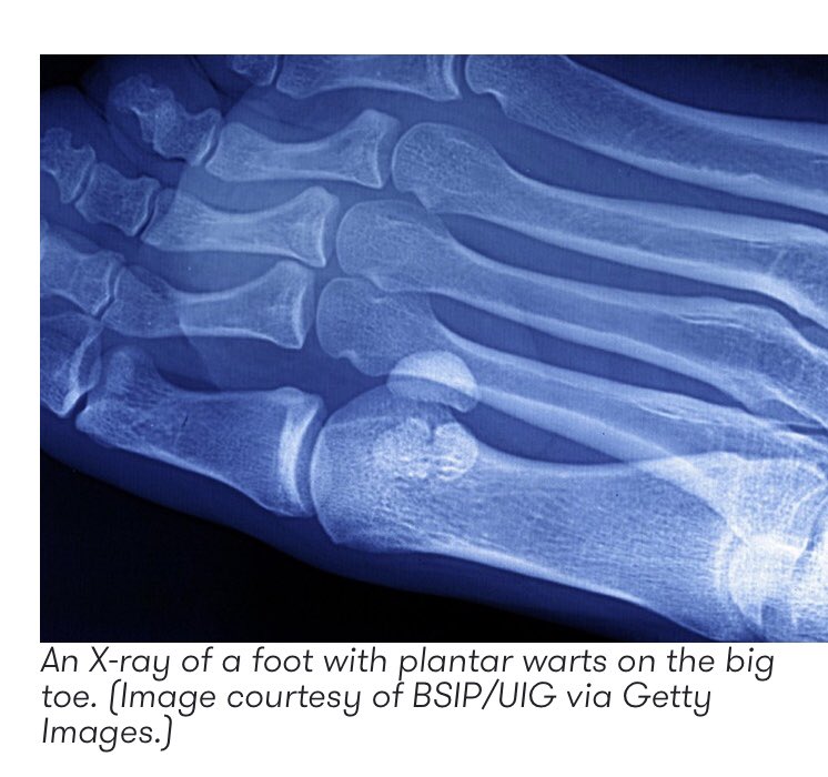 Plantar Warts Diagram