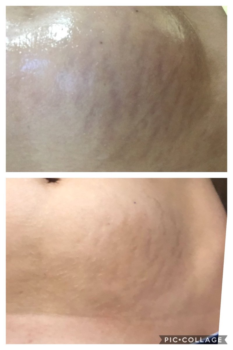 ErinMeierOKC's tweet photo. Innopen for the Win (So long stretch marks!) https://t.co/ZWKp0OpDvR https://t.co/D90PLzeR1A
