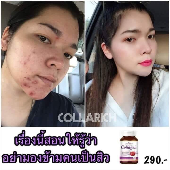 26Collarich's tweet photo. เคยเป็นสิวขาดความมั่นใจ ไหนจะรอยดำอีก 💢

🤷🏻‍♀️พอกันทีกับปัญหาผิวหน้า ขาดความมั่นใจ จัดการง่ายๆด้วย #collarich 

👉🏻คอลลาริช มีส่วนประกอบของ Zinc ช่วยลดความมันบนใบหน้า สาเหตุของการเกิดสิว และยังมี อะเซโรลาเชอรี่ ช่วยให้ผิวกระจ่างใส ลดริ้วรอยที่เกิดจากสิวอีกด้วย 
#สิวหาย https://t.co/r2kCZTmvsk