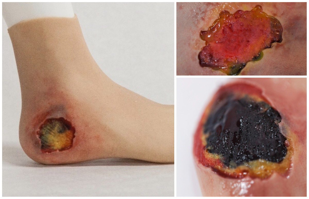 SIMESSENTIALS's tweet photo. Nursing and Wound Care #SIMSLEEVES, various grades of pressure #ulcers and infected wounds. #simessentials #woundcare #medical @TraumaFXUK @Prometheusmed https://t.co/h1w0Ykfjfz