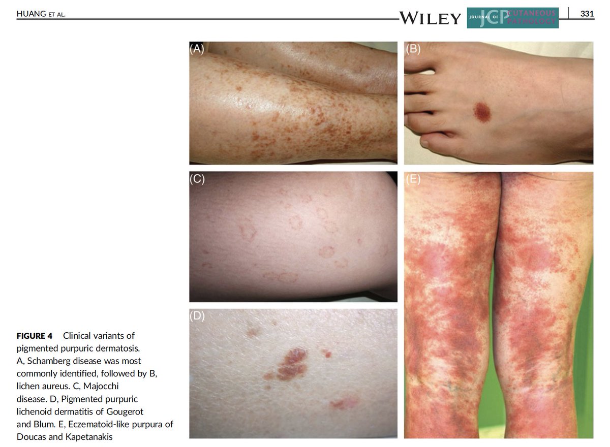 Dermpathjc Ppd Clinical Dermpathjc Purpuric Macules Schamberg S Disease Lichenoid Purpuric Papules Gougerot Blum Annular Purpuric Patches W Telangiectasia Majocchi S Dz Gold Brown Patches Plaques Lichen Aureus Eczematous