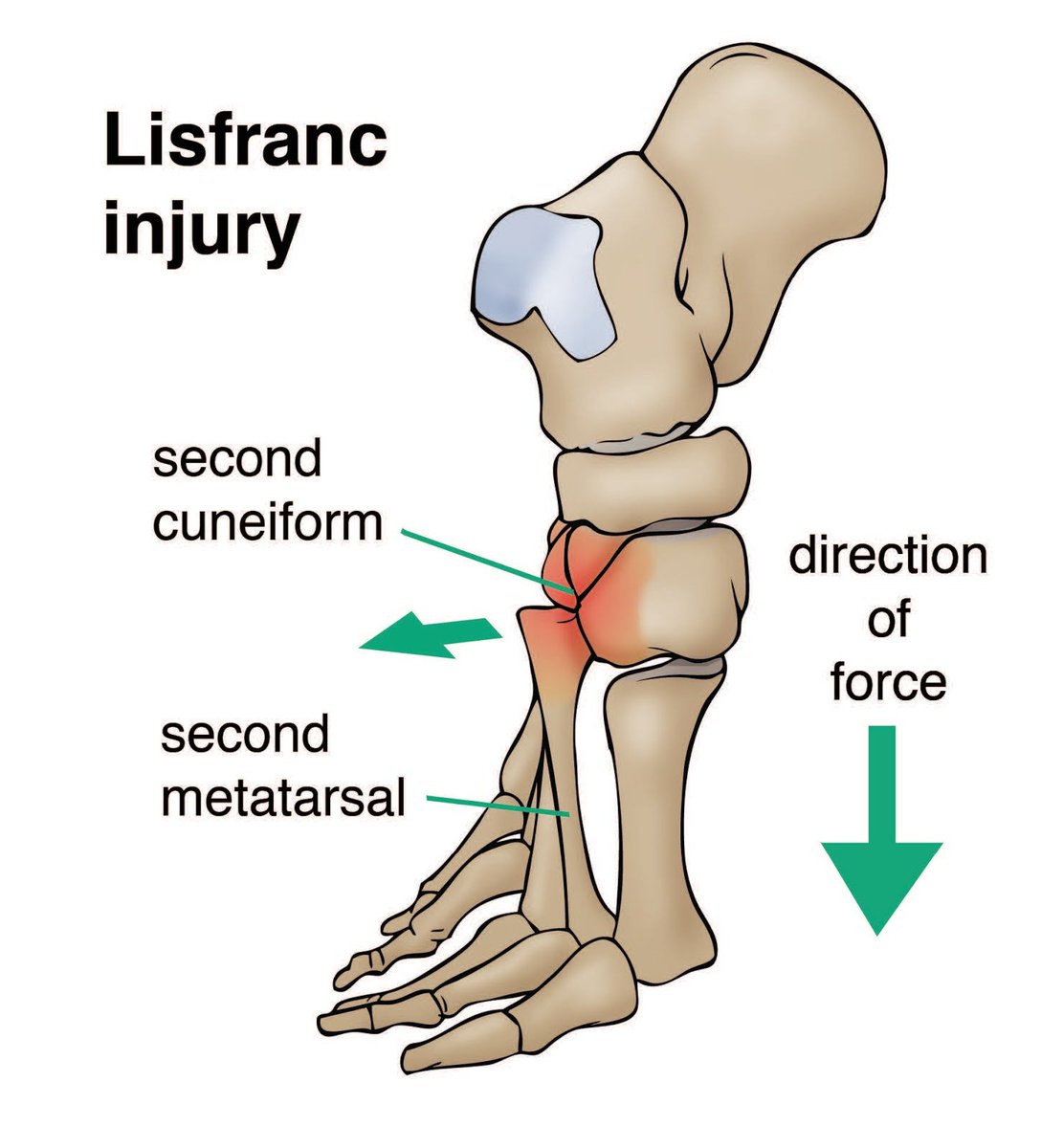 TheBiomechLab's tweet image. The Lisfranc Injury - commonly described as a foot or low ankle sprain and the reason behind the indefinite sidelining of AFL stars Rory Sloane and Daniel Wells.
Head to the link below to find out more about this complex and potentially devastating injury.
bit.ly/2KwY01B