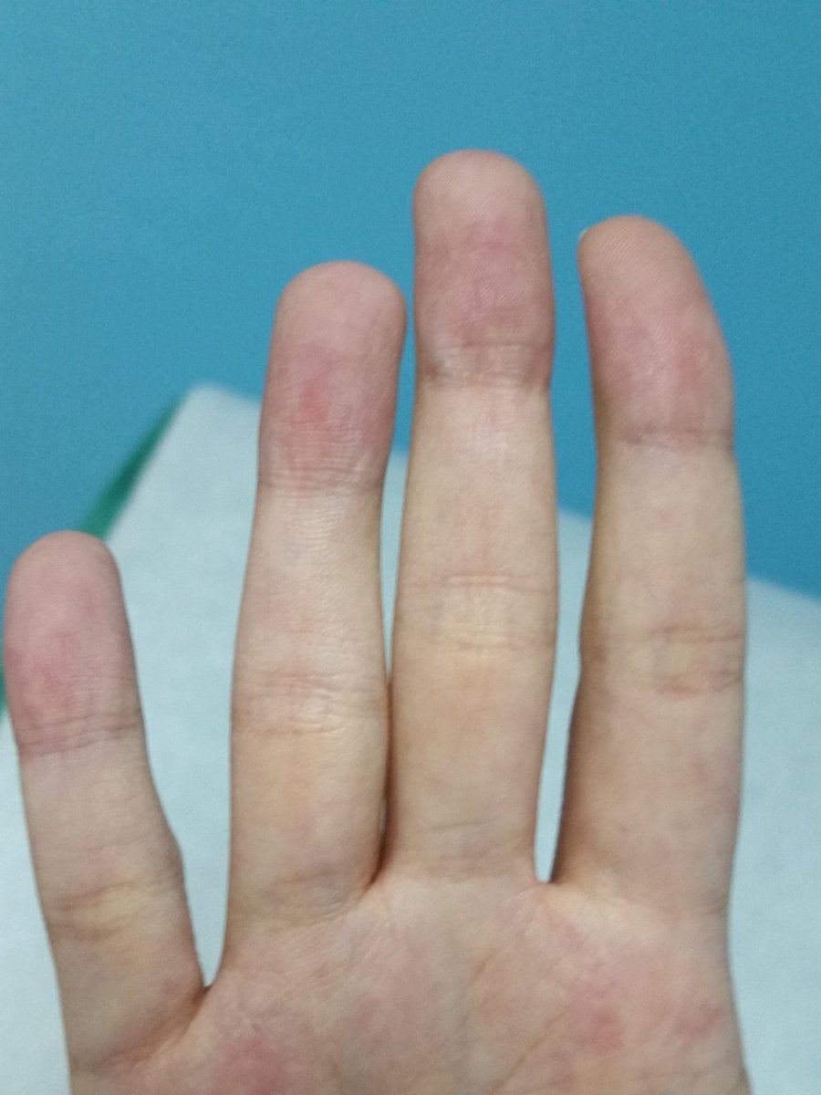 rmunozlouis's tweet photo. Fenómeno de #Raynaud de las primeras manifestaciones de la #escleroderma https://t.co/ULoMqMHkat