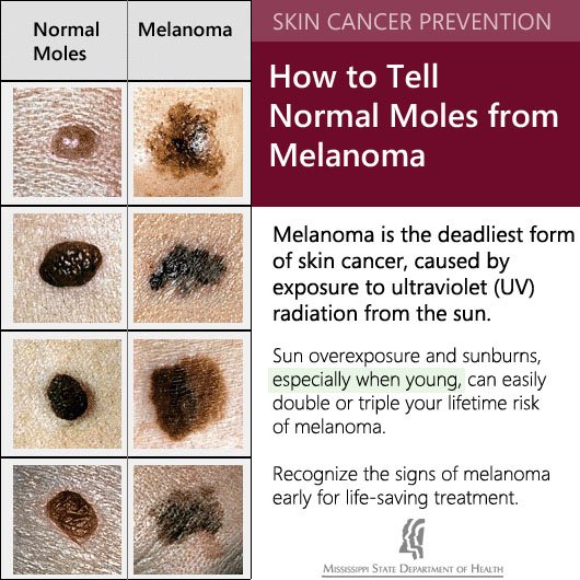 cancerous moles vs normal moles